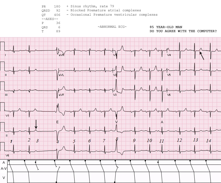 sinus-rhythm-with-ectopy-ecg-guru-instructor-resources